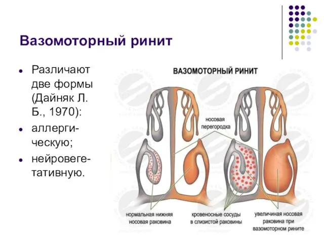 Вазомоторный ринит Различают две формы (Дайняк Л.Б., 1970): аллерги-ческую; нейровеге-тативную.