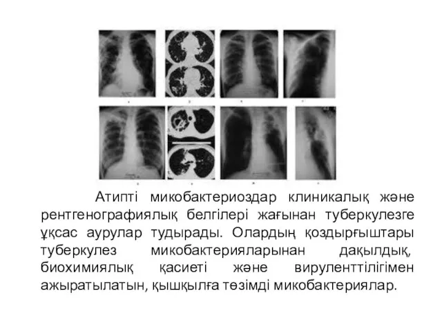 Атипті микобактериоздар клиникалық және рентгенографиялық белгілері жағынан туберкулезге ұқсас аурулар