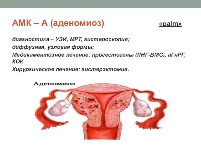 АМК – А (аденомиоз) «palm» диагностика – УЗИ, МРТ, гистероскопия;