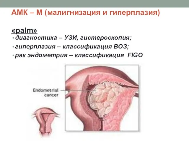 АМК – М (малигнизация и гиперплазия) «palm» диагностика – УЗИ,