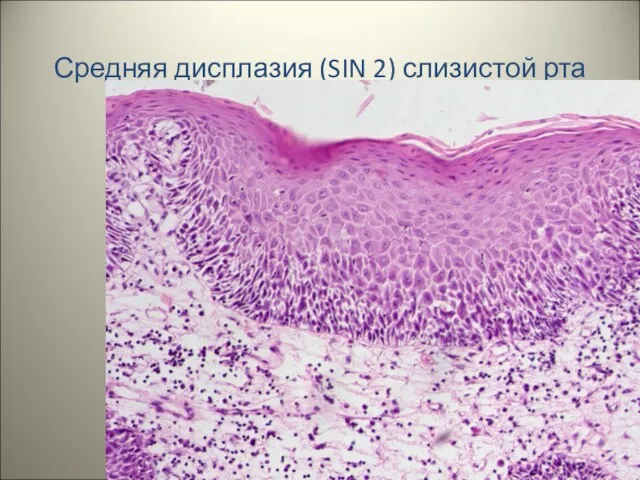 Средняя дисплазия (SIN 2) слизистой рта