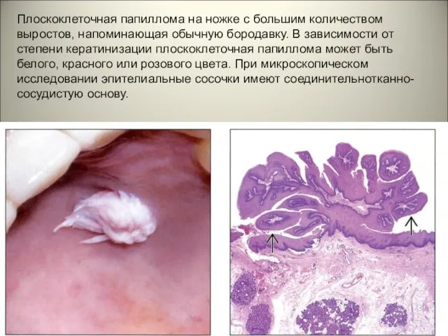 Плоскоклеточная папиллома на ножке с большим количеством выростов, напоминающая обычную