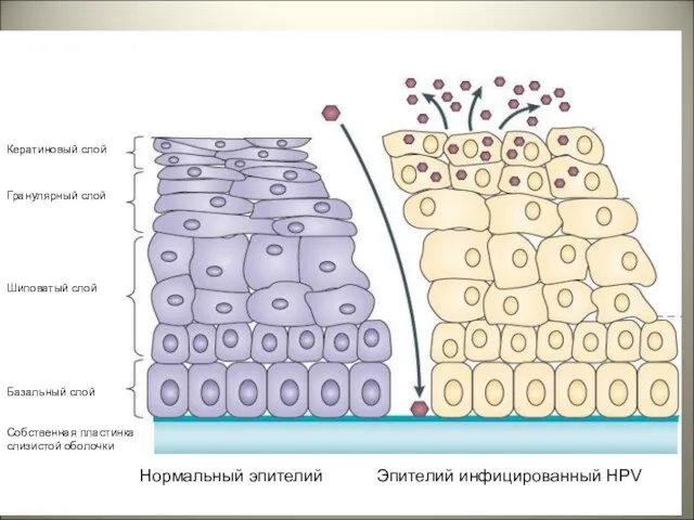 Нормальный эпителий Эпителий инфицированный HPV Кератиновый слой Гранулярный слой Шиповатый