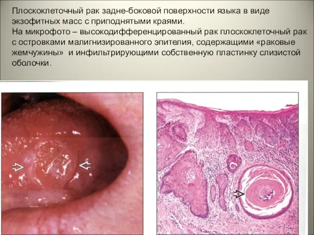 Плоскоклеточный рак задне-боковой поверхности языка в виде экзофитных масс с