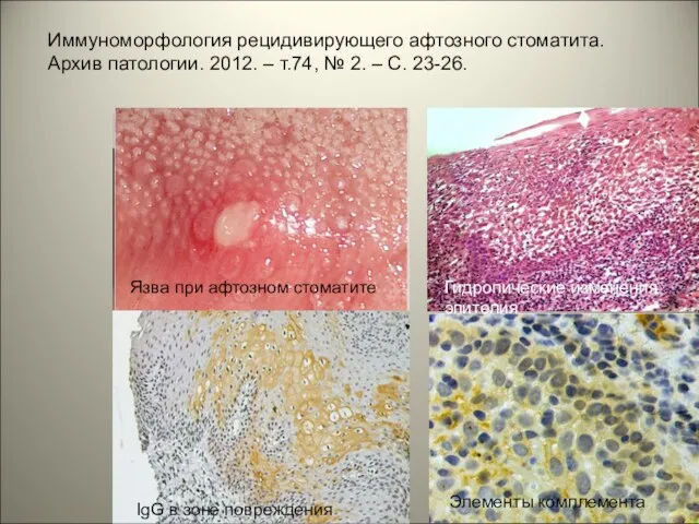 Язва при афтозном стоматите Гидропические изменения эпителия IgG в зоне