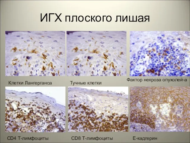ИГХ плоского лишая Клетки Лангерганса Тучные клетки Фактор некроза опухолей-а CD4 Т-лимфоциты CD8 Т-лимфоциты Е-кадгерин