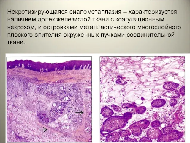 Некротизирующаяся сиалометаплазия – характеризуется наличием долек железистой ткани с коагуляционным