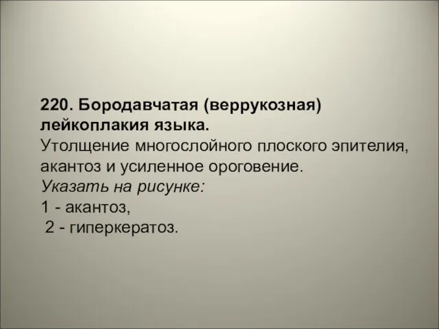 220. Бородавчатая (веррукозная) лейкоплакия языка. Утолщение многослойного плоского эпителия, акантоз