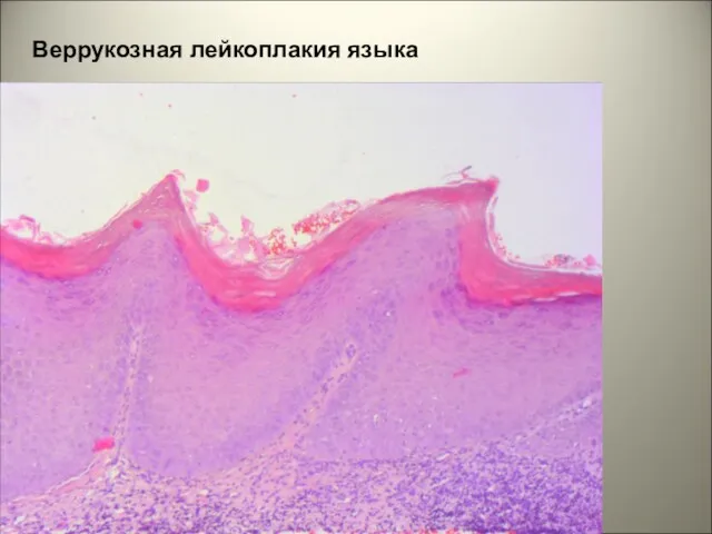 Веррукозная лейкоплакия языка