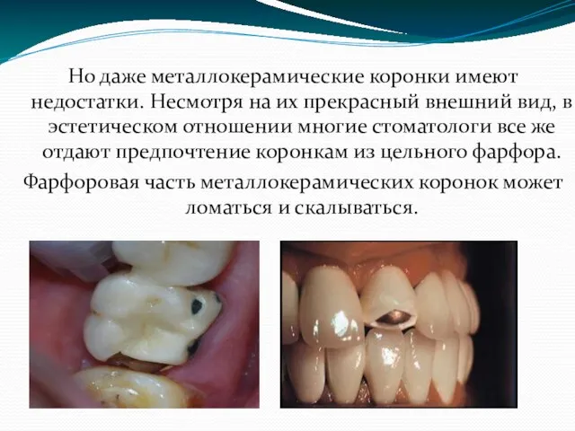 Но даже металлокерамические коронки имеют недостатки. Несмотря на их прекрасный