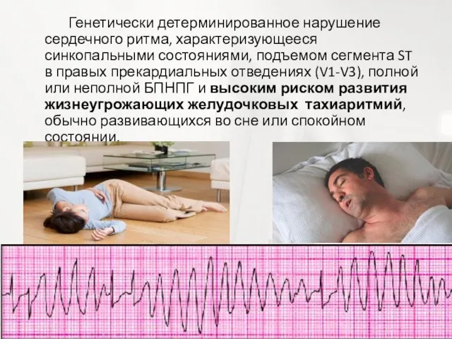 Генетически детерминированное нарушение сердечного ритма, характеризующееся синкопальными состояниями, подъемом сегмента