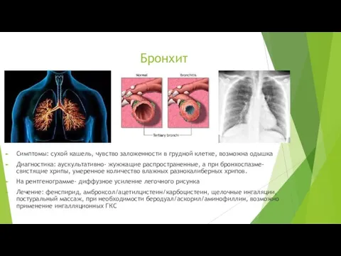 Бронхит Симптомы: сухой кашель, чувство заложенности в грудной клетке, возможна