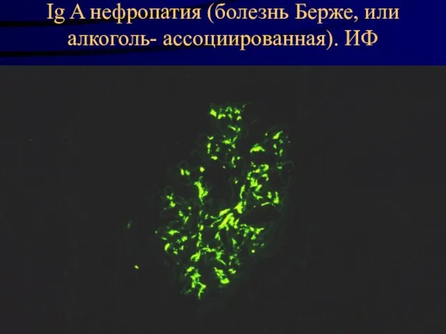 Ig A нефропатия (болезнь Берже, или алкоголь- ассоциированная). ИФ