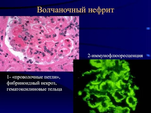 Волчаночный нефрит 1- «проволочные петли», фибриноидный некроз, гематоксилиновые тельца 2-иммунофлюоресценция