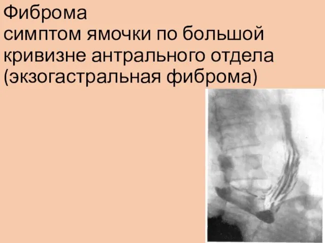 Фиброма симптом ямочки по большой кривизне антрального отдела (экзогастральная фиброма)