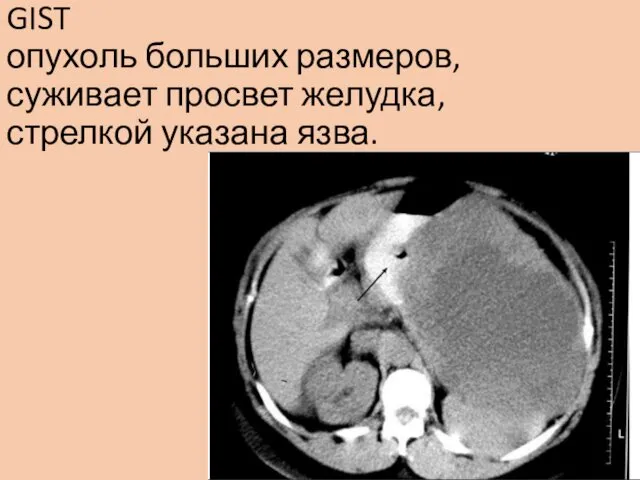 GIST опухоль больших размеров, суживает просвет желудка, стрелкой указана язва.