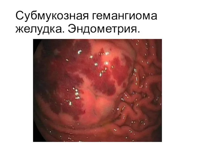 Субмукозная гемангиома желудка. Эндометрия.