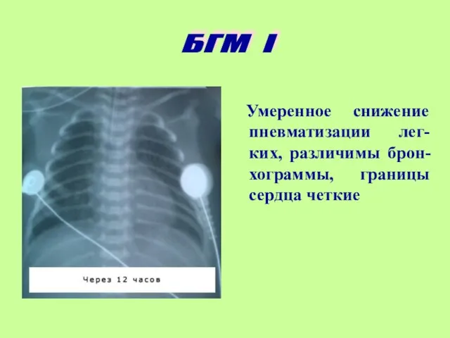 Умеренное снижение пневматизации лег-ких, различимы брон-хограммы, границы сердца четкие БГМ I