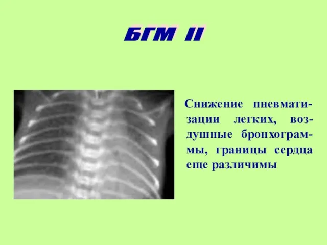 Снижение пневмати-зации легких, воз-душные бронхограм-мы, границы сердца еще различимы БГМ II