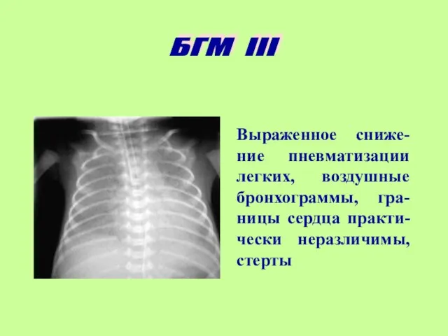 Выраженное сниже-ние пневматизации легких, воздушные бронхограммы, гра-ницы сердца практи-чески неразличимы, стерты БГМ III