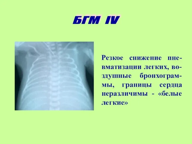 Резкое снижение пне-вматизации легких, во-здушные бронхограм-мы, границы сердца неразличимы - «белые легкие» БГМ IV