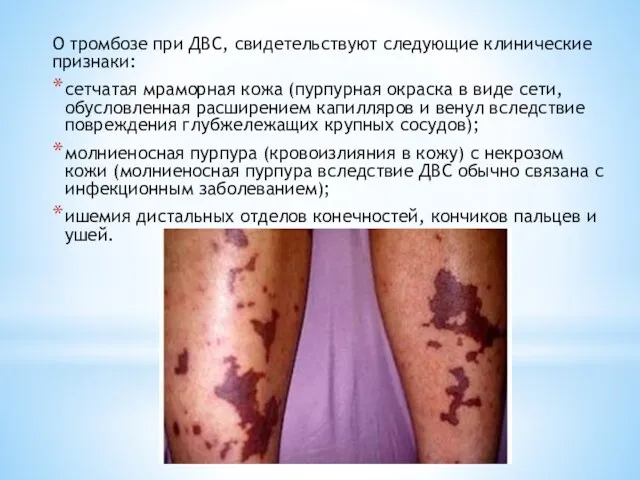 О тромбозе при ДВС, свидетельствуют следующие клинические признаки: сетчатая мраморная кожа (пурпурная окраска