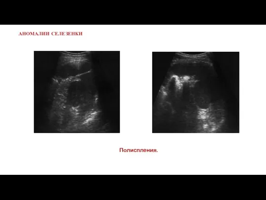 АНОМАЛИИ СЕЛЕЗЕНКИ Полиспления.