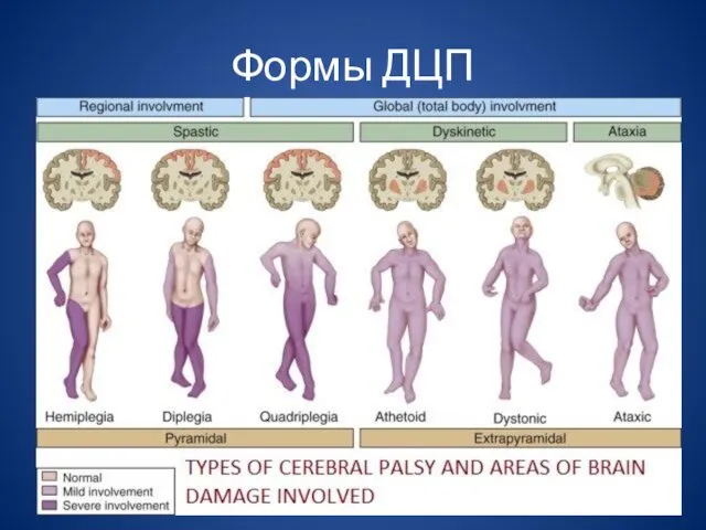 Формы ДЦП