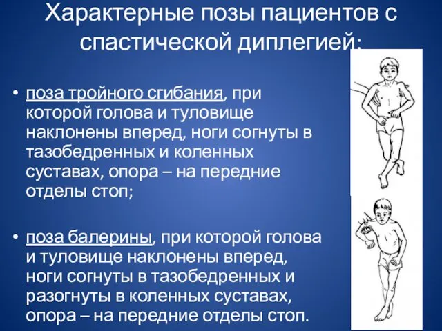 Характерные позы пациентов с спастической диплегией: поза тройного сгибания, при