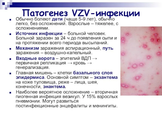 Патогенез VZV-инфекции Обычно болеют дети (чаще 5-9 лет), обычно легко,