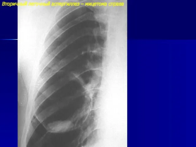 Вторичный легочный аспергиллез – мицетома справа