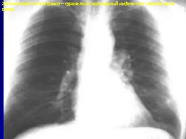 Хронический гистоплазмоз – единичный шаровидный инфильтрат нижней доли слева