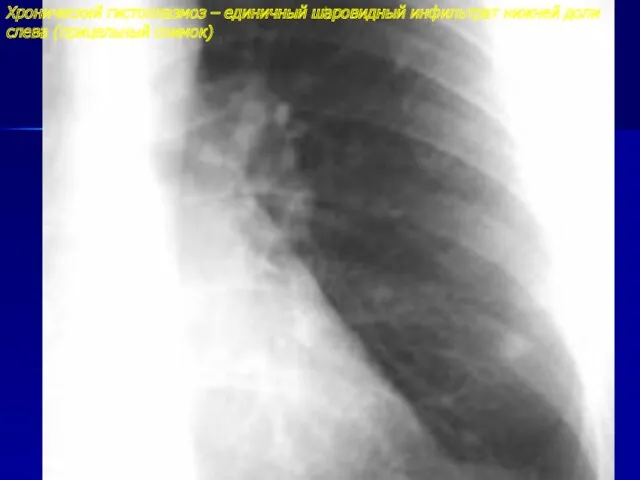 Хронический гистоплазмоз – единичный шаровидный инфильтрат нижней доли слева (прицельный снимок)