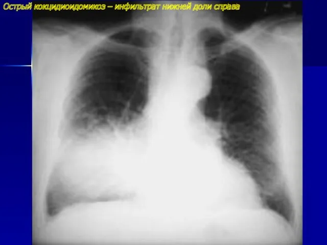 Острый кокцидиоидомикоз – инфильтрат нижней доли справа