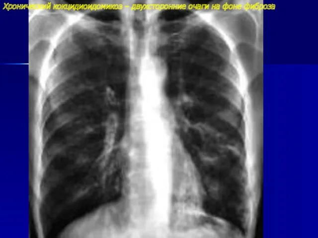 Хронический кокцидиоидомикоз – двухсторонние очаги на фоне фиброза