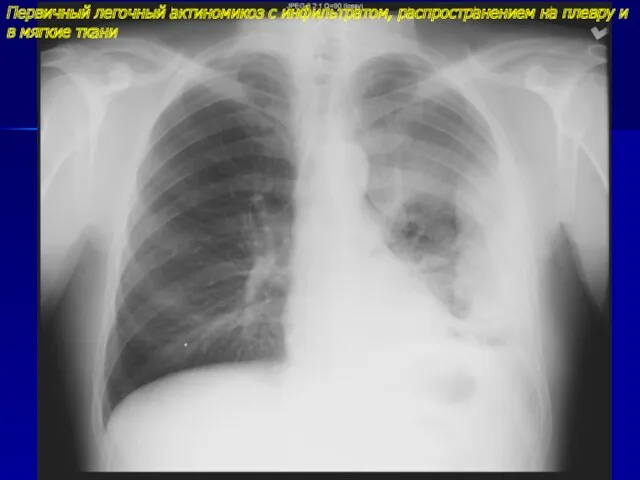 Первичный легочный актиномикоз с инфильтратом, распространением на плевру и в мягкие ткани