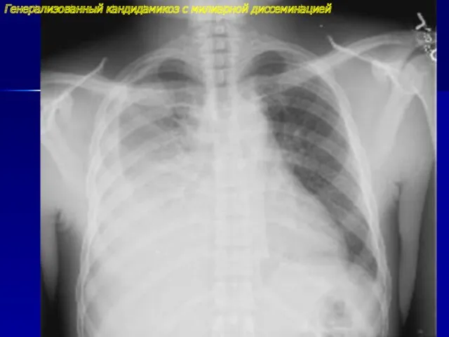 Генерализованный кандидамикоз с милиарной диссеминацией