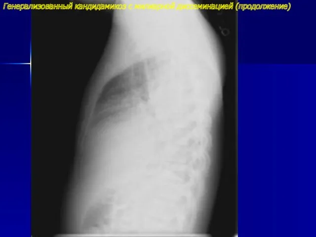 Генерализованный кандидамикоз с милиарной диссеминацией (продолжение)