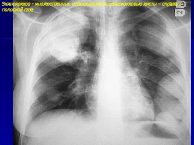 Эхинококкоз - множественные невскрывшиеся эхинококковые кисты – справа с полоской газа