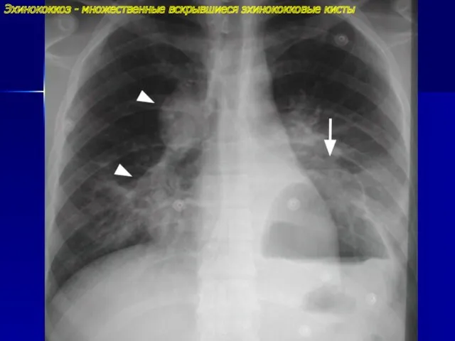 Эхинококкоз - множественные вскрывшиеся эхинококковые кисты