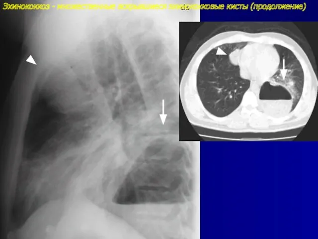 Эхинококкоз - множественные вскрывшиеся эхинококковые кисты (продолжение)