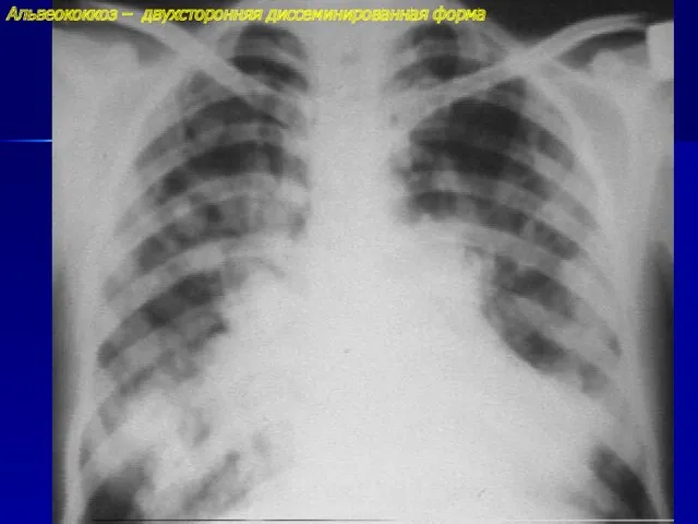 Альвеококкоз – двухсторонняя диссеминированная форма