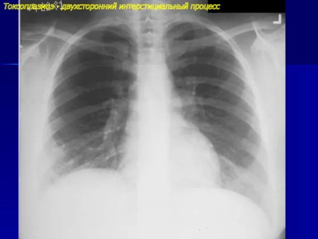 Токсоплазмоз - двухсторонний интерстициальный процесс