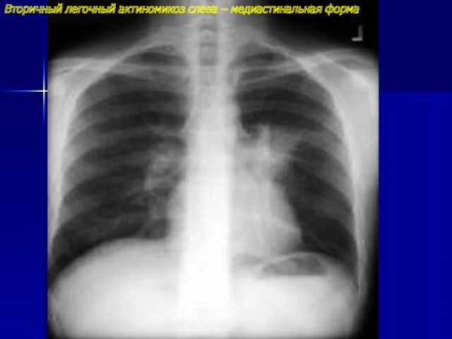 Вторичный легочный актиномикоз слева – медиастинальная форма