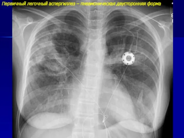 Первичный легочный аспергиллез – пневмоническая двусторонняя форма