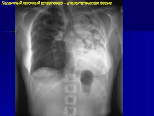 Первичный легочный аспергиллез – ателектатическая форма
