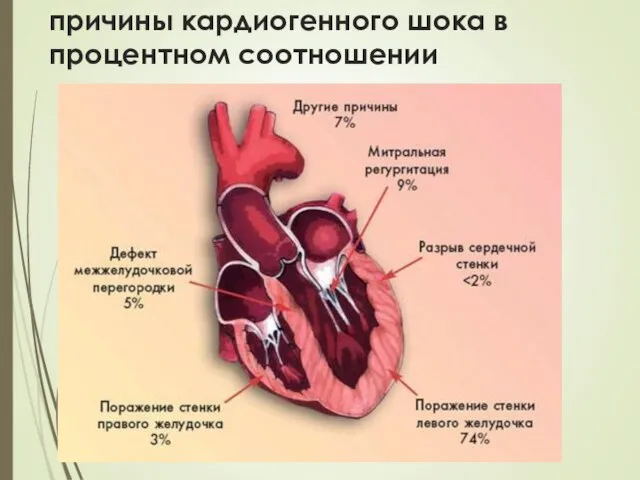 причины кардиогенного шока в процентном соотношении