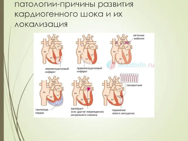 патологии-причины развития кардиогенного шока и их локализация