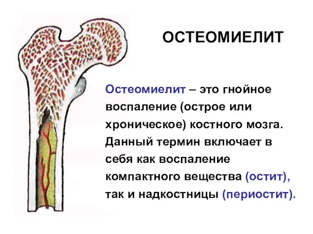 ОСТЕОМИЕЛИТ Остеомиелит – это гнойное воспаление (острое или хроническое) костного мозга. Данный термин