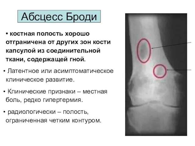 • костная полость хорошо отграничена от других зон кости капсулой из соединительной ткани,